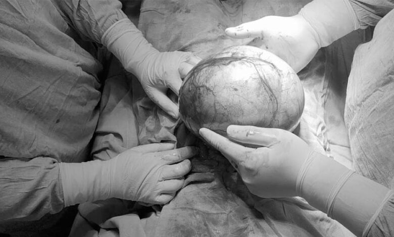 बुरहानपुर में डॉक्टरों का मिरेकल: 57 वर्षीय महिला के पेट से 8 किलो का ट्यूमर निकाला